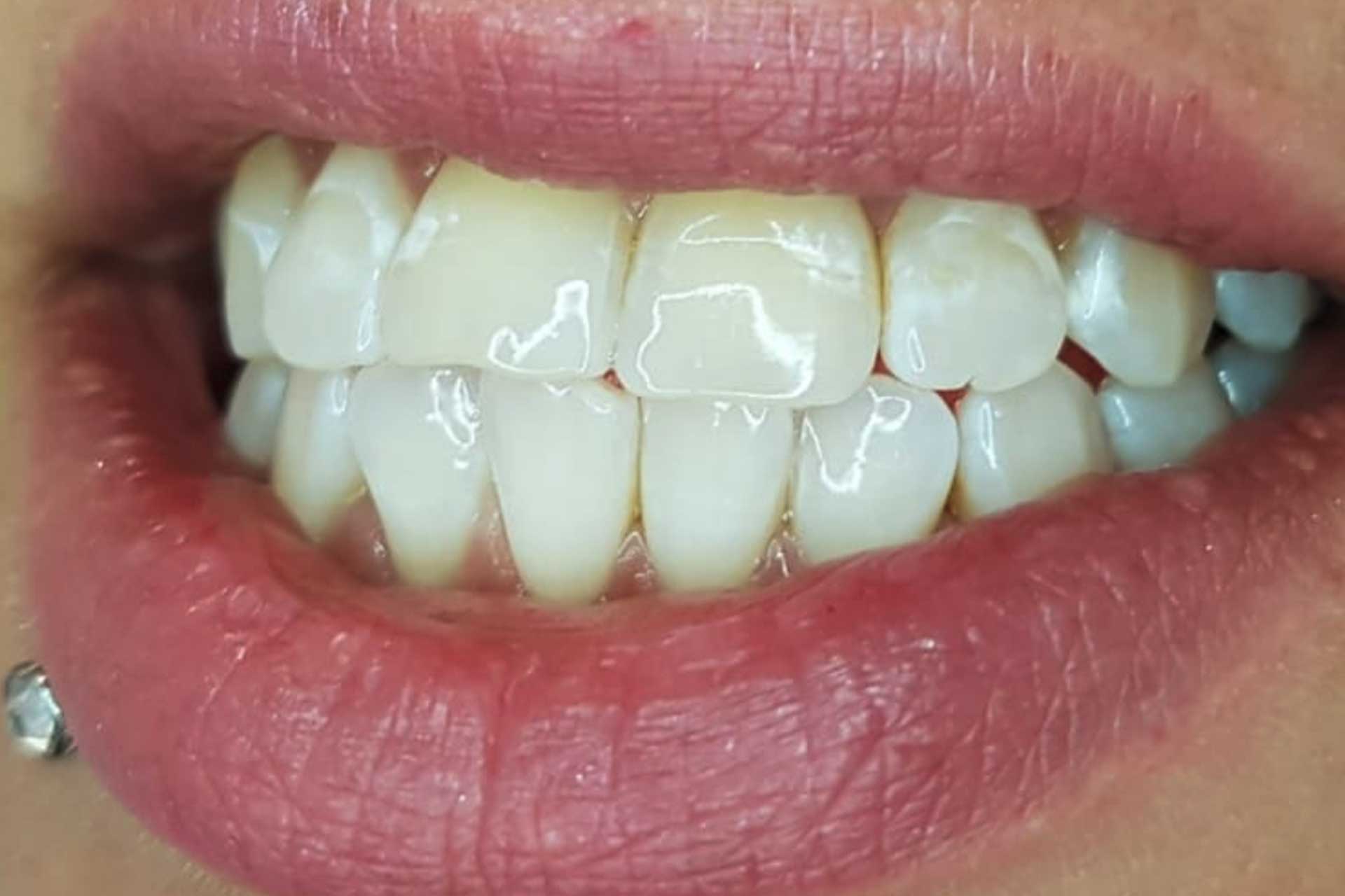 kosmetische Zahnaufhellung